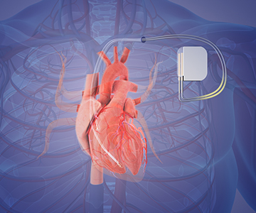 Image of heart inside a rib cage with pacemaker