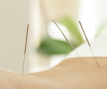Acupuncture needles in a back