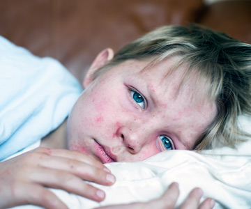 Young boy with measles. His head on a pillow.