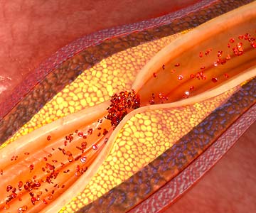 Illustration of plaque build-up in arteries limiting blood flow.