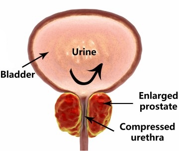Illustration of a bladder with an enlarged prostate compressing the urethra below the bladder.