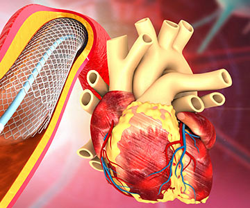 Illustration of human heart with angioplasty/stent implant.