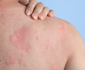 A close up of a woman's back with hives on her skin.