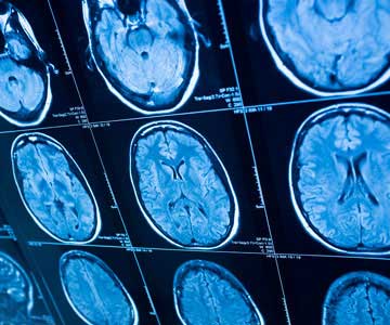 MRI brain scan