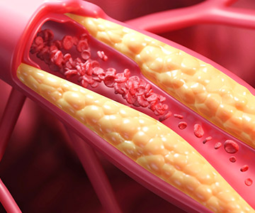 Blood flowing through an artery that has plaque buildup