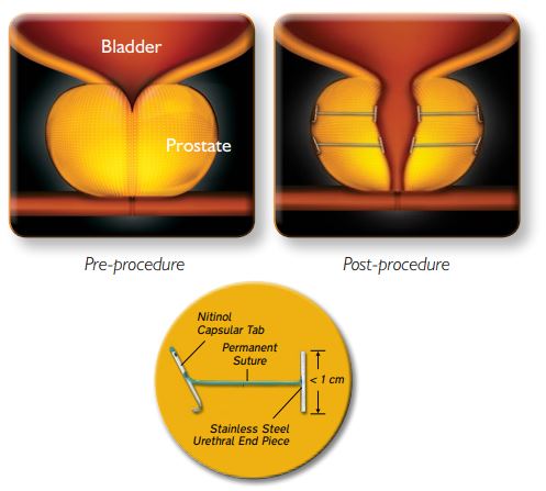 A before and after illustration shows how the the Urolift treatment works.